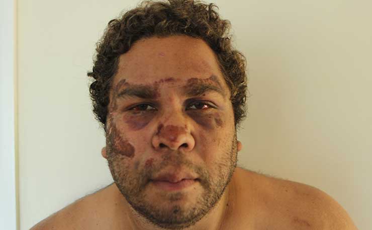 Leon Petrou, pictured shortly after being assaulted during an arrest by Queensland Police in 2013.
