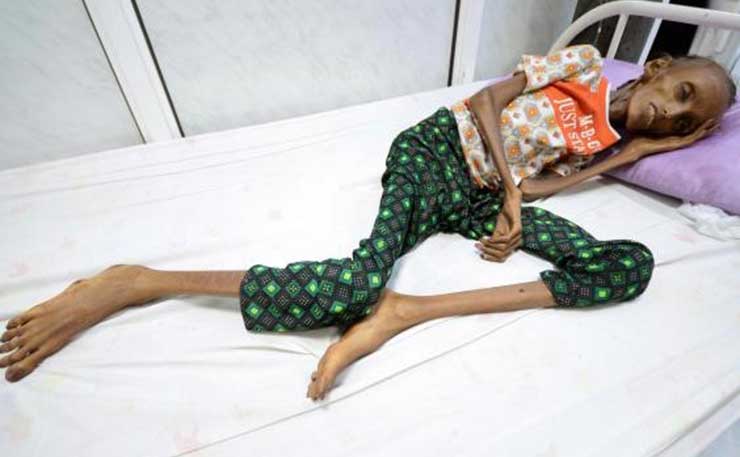 Saida Ahmad Baghili, 18, suffers from severe acute malnutrition (Reuters).