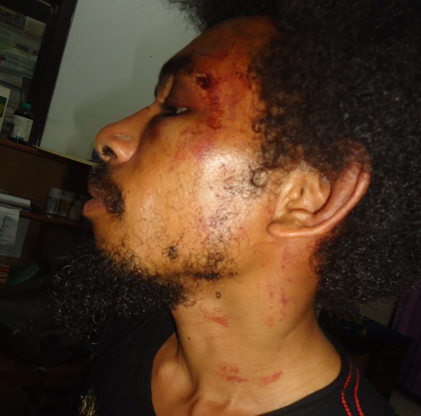 Alfares Kapissa, with injuries sustained in police custody including marks on his neck from a stun gun