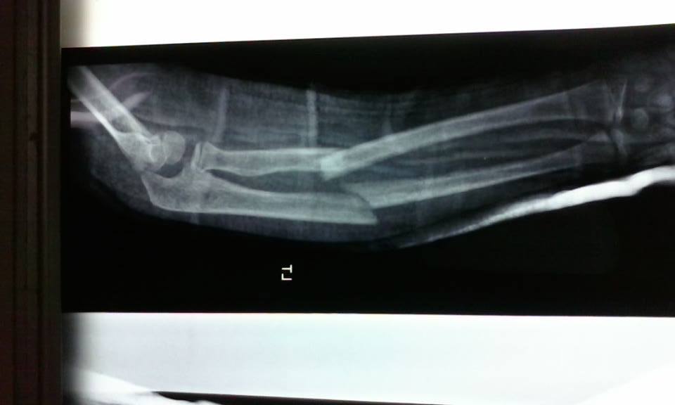 An x-ray showing the boy's fracture.