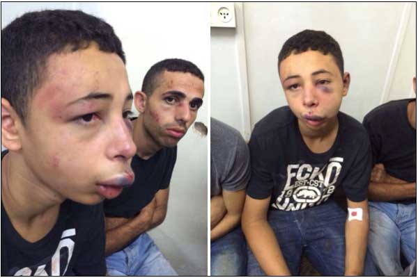 Tarek Abu Khdeir, a 15-year-old American citizen, was beaten severely by Israeli soldiers.